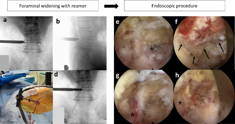 Cost-effectiveness analysis of extended endoscopic lumbar foraminotomy (EELF) and transforaminal lumbar interbody fusion (TLIF): a prospective observational study.