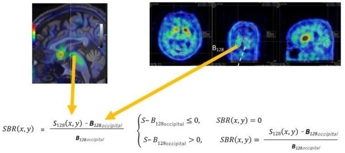 Use of the specific binding ratio distribution to characterise multiple system atrophy in advanced iodine-123-labelled N-(3-fluoropropyl)-2β-carbomethoxy-3β-(4-iodophenyl) nortropane serotonin transporter imaging.