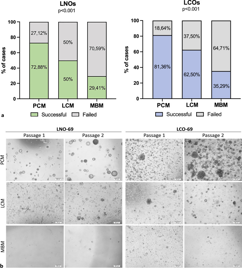 Selection of the Most Suitable Culture Medium for Patient-Derived Lung Cancer Organoids.
