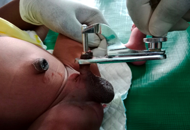 A Comparison of Three Techniques in Neonatal Circumcision: Artery Forceps, Bone-cutter, and Gomco Clamp Methods.