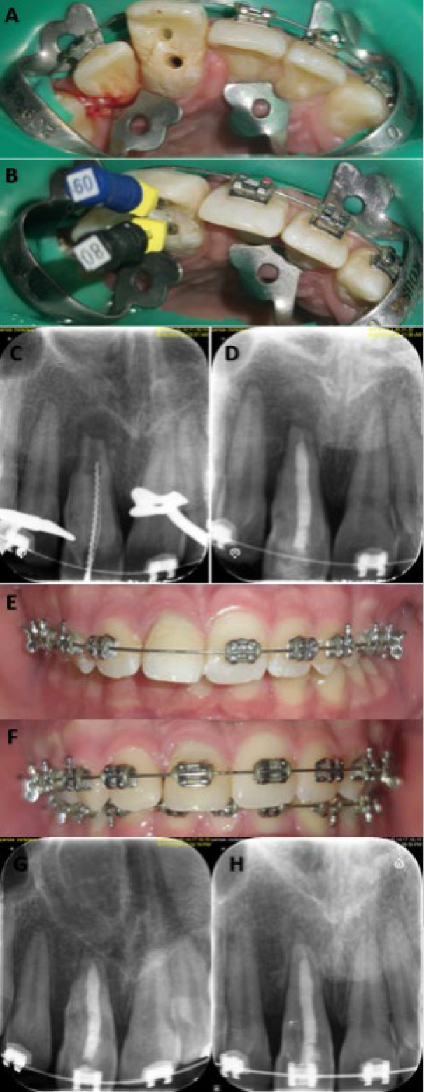 Nonsurgical Endodontic Treatment of Type IIIa Dens Invaginatus in an Immature Maxillary Central Incisor: A Case Report.