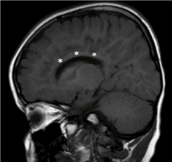 Spondyloenchondrodysplasia with immune dysregulation: an under-the-radar cause of spasticity.