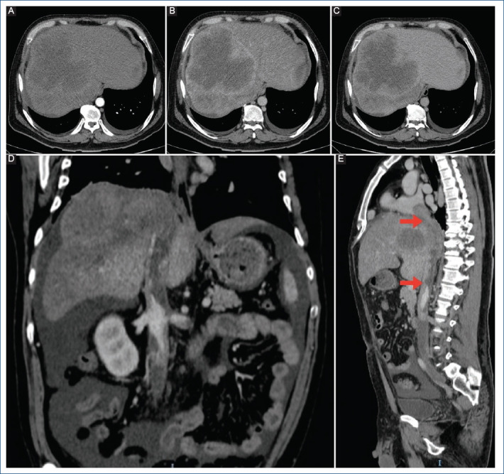 Hepatocellular carcinoma with inferior vena cava tumor thrombus extending into cardiac chambers: case report.