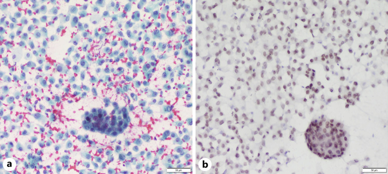 Diagnostic and Predictive Immunocytochemistry in Lung Cancer.