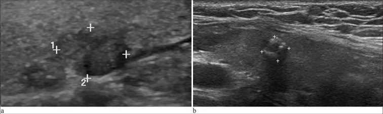 Histopathological findings of 687 thyroid nodules, suspicious for malignancy on ultrasound, with an indeterminate cytopathological diagnosis after the combination of the Bethesda System and <i>BRAF</i> mutation status.
