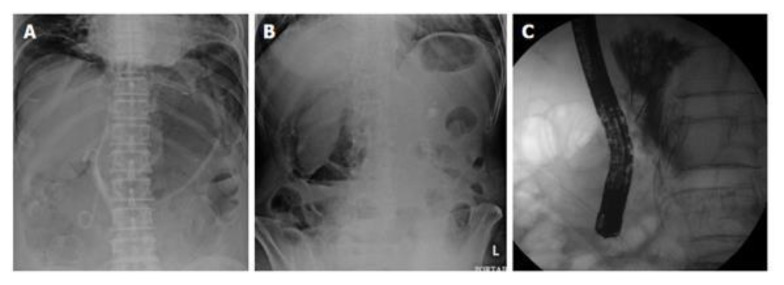 ERCP and complications of small bowel perforation.