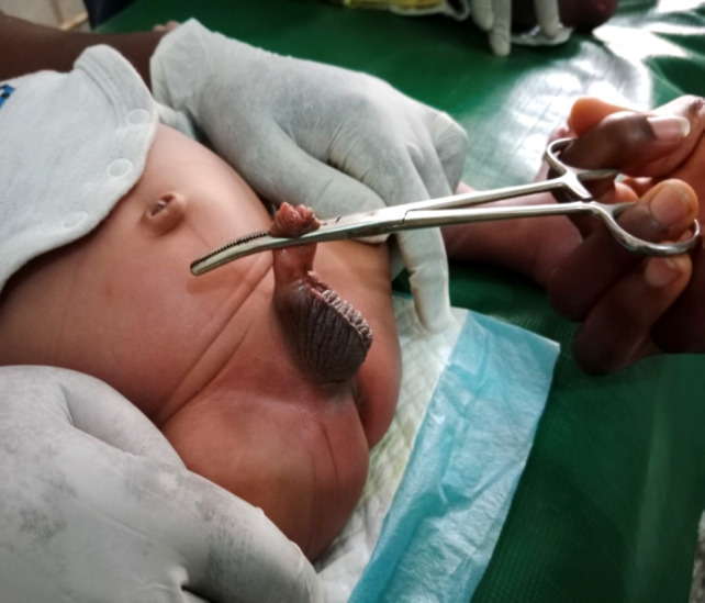 A Comparison of Three Techniques in Neonatal Circumcision: Artery Forceps, Bone-cutter, and Gomco Clamp Methods.