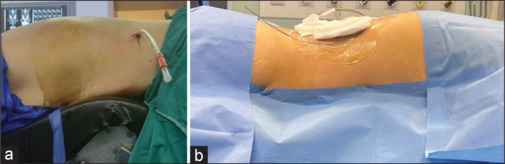Prone versus prone-flexed position in percutaneous nephrolithotomy: A randomized controlled trial.