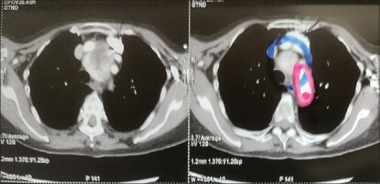 A Case of Life-Threatening Contralateral Tension Pneumothorax during Video-Assisted Thoracic Surgery in a Patient with Retrosternal Goiter.