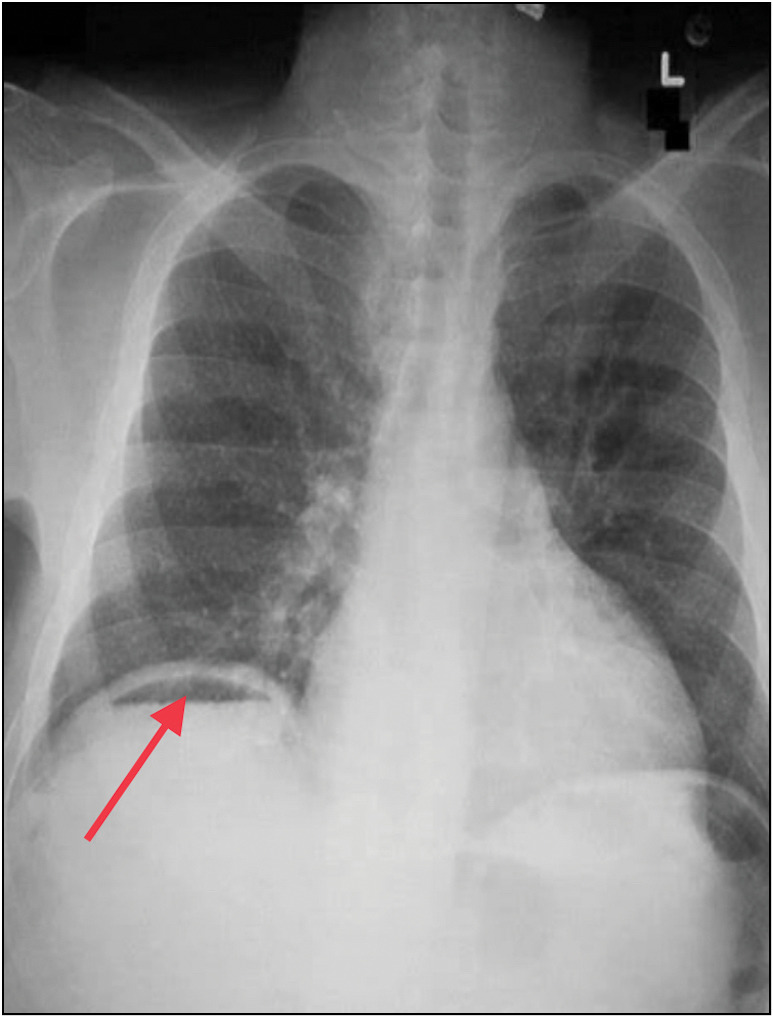A Diagnostic Dilemma of Emphysematous Liver Abscess with Gas under the Diaphragm: A Case Report and Review of Literature.