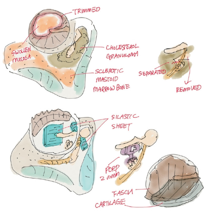 Joy of Electronic Drawing for Operative Notes: Enhancing Surgical Documentation.