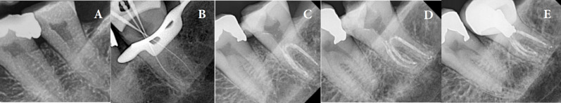 Endodontic Management of Hypertaurodontic Teeth: A Report of Three Cases.