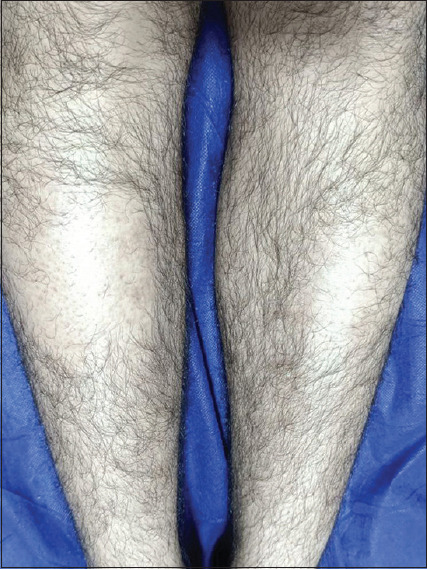 Anterolateral Leg Alopecia: Clinical, Histopathological, and Dermoscopic Features.
