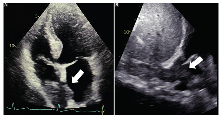 Hepatocellular carcinoma with inferior vena cava tumor thrombus extending into cardiac chambers: case report.
