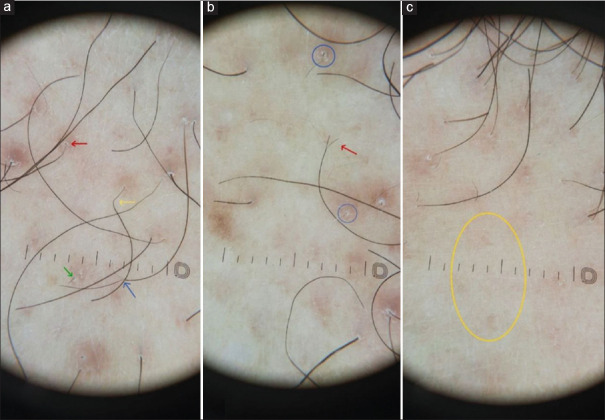Anterolateral Leg Alopecia: Clinical, Histopathological, and Dermoscopic Features.