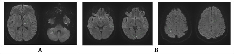 Neurological Crisis Following Intravenous Ozone Therapy; a Case Report.