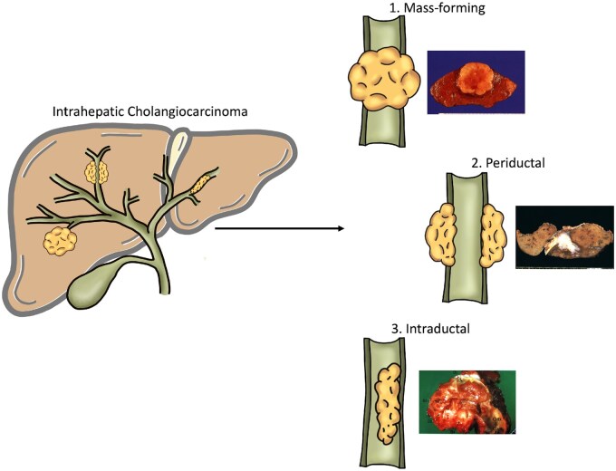 Management of intrahepatic cholangiocarcinoma: a review for clinicians.
