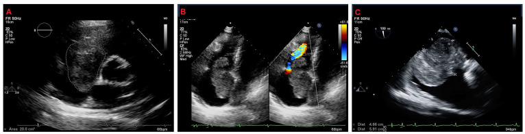 Giant Right Atrial Myxoma Presenting With Right Heart Failure.