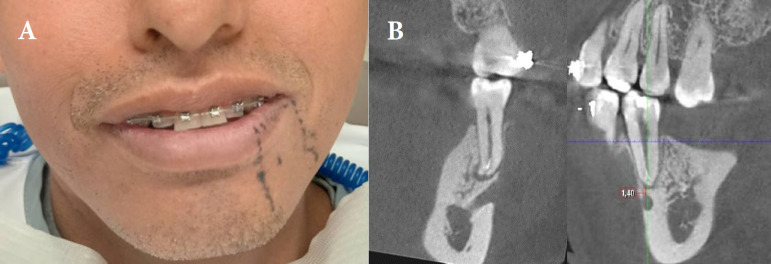 Mental Nerve Paresthesia, a Complication of Anesthesia in Non-surgical Endodontic Treatment: A Case Report .