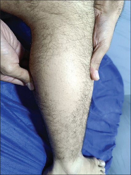 Anterolateral Leg Alopecia: Clinical, Histopathological, and Dermoscopic Features.