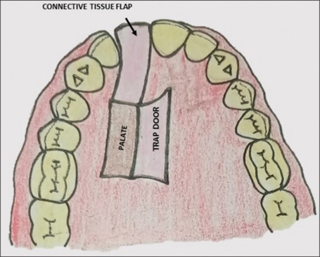 Vascularized interpositional periosteal connective tissue flap: A comprehensive review.