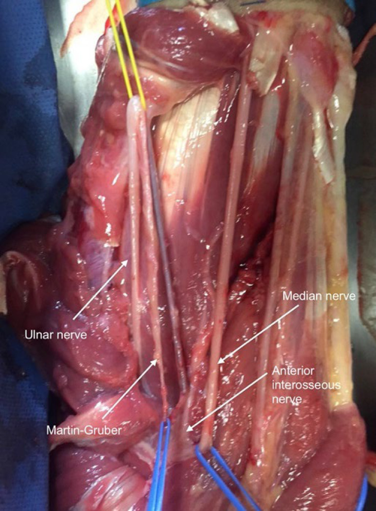 Presence of Martin-Gruber Anastomosis among a Cohort of Mexican Origin; a Corpse Dissection Study.