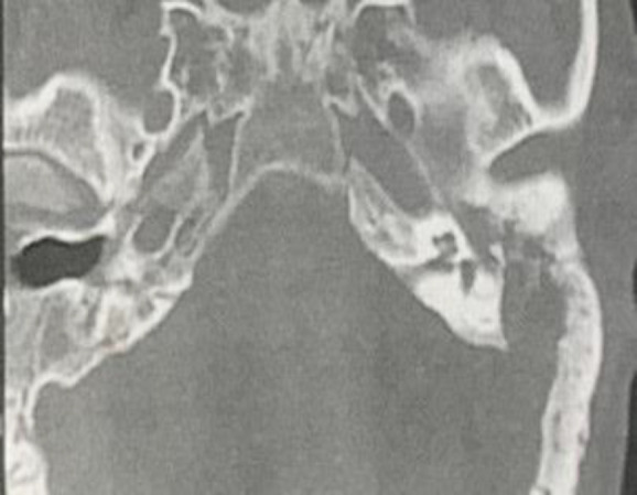 Otoscleroma of the Middle Ear and Mastoid Cavity with Facial Palsy: A Case Report.
