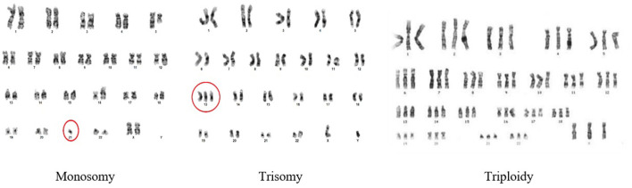 Automated karyogram analysis for early detection of genetic and neurodegenerative disorders: a hybrid machine learning approach.
