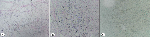 Carcinoma Cuniculatum Masquerading as Eumycetoma: An Unacquainted Entity Posing a Diagnostic Dilemma.