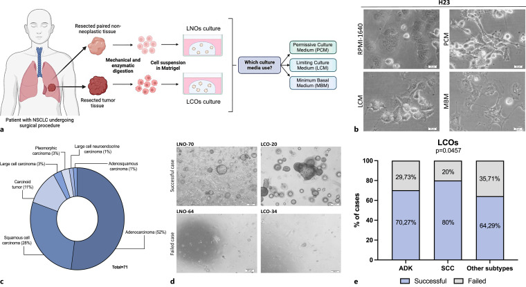 Selection of the Most Suitable Culture Medium for Patient-Derived Lung Cancer Organoids.