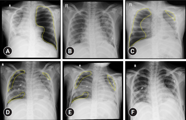 Bilateral spontaneous pneumothorax in lupus erythematosus and the role of low-dose intravenous immunoglobulin.