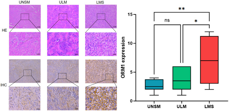 Orosomucoid 1 is a Potential Prognostic Biomarker for Uterine Sarcoma.