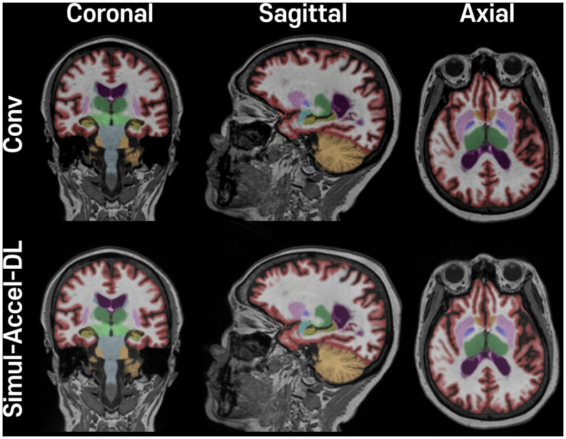 Reliability of brain volume measures of accelerated 3D T1-weighted images with deep learning-based reconstruction.