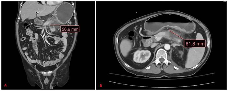 Rare Case of Acute Pancreatitis Presenting With ST-Segment Elevation.