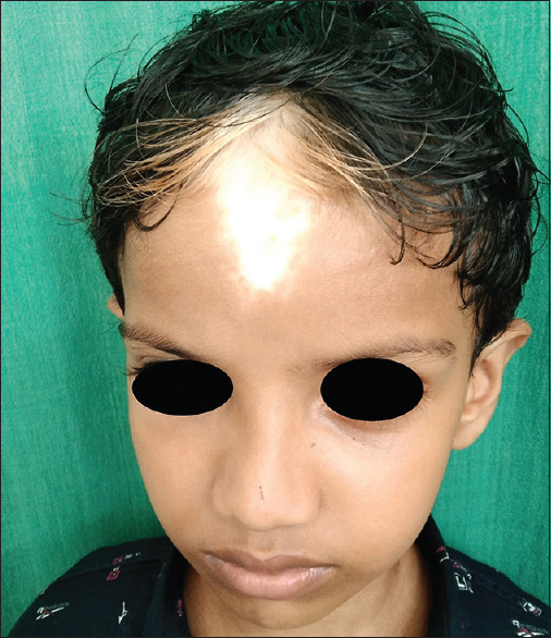 Waardenburg Syndrome in a Family.