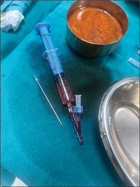 Unusual Retrieval of Dislodged Introducer Needle from Right Jugular Vein Using a Magnet.