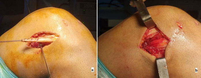 Differences in Clinical Outcomes and Rotational Stability Between Anterolateral Ligament Reconstruction and Lemaire Lateral Tenodesis Following Primary Anterior Cruciate Ligament Reconstruction.