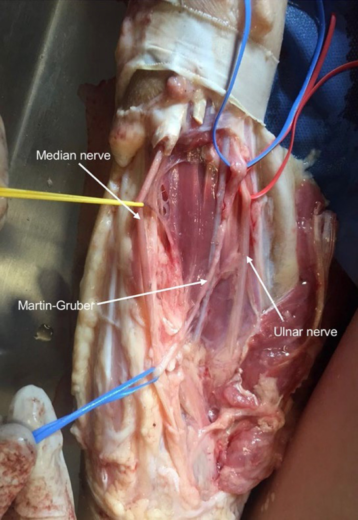 Presence of Martin-Gruber Anastomosis among a Cohort of Mexican Origin; a Corpse Dissection Study.