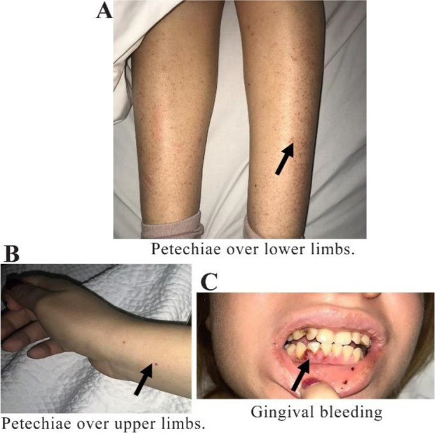 Severe Immune Thrombocytopenic Purpura in a Patient at 33 Weeks of Gestation: A Case Report.