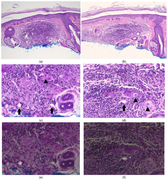 Asteroid Shower: Cutaneous Silica Granuloma with Asteroid Bodies.