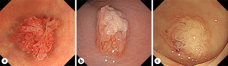 Endoscopic and Clinicopathological Features of a Colorectal Mucin-Rich Variant of Traditional Serrated Adenoma.
