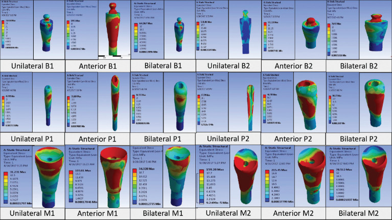 Comparative evaluation of pattern and distribution of stresses in single- and double-implant overdenture using ball-ring, positioner, and magnet-keeper attachment under different loading conditions: A finite element analysis.