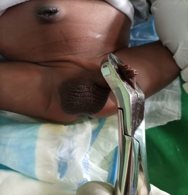 A Comparison of Three Techniques in Neonatal Circumcision: Artery Forceps, Bone-cutter, and Gomco Clamp Methods.