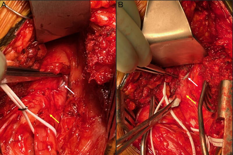 Profound Neuropathy after Penetrating Transection of the Sciatic Nerve by Femoral Cerclage Wire: Illustrative Case and Management Strategy.