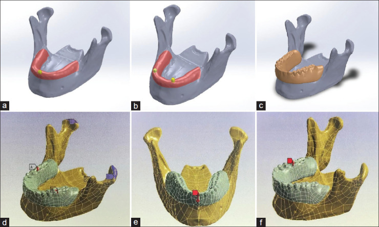 Comparative evaluation of pattern and distribution of stresses in single- and double-implant overdenture using ball-ring, positioner, and magnet-keeper attachment under different loading conditions: A finite element analysis.