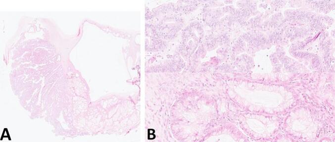 Primary retroperitoneal mucinous carcinoma with BRAF, KIT, NF2, and AR mutations: A case report and review of the literature