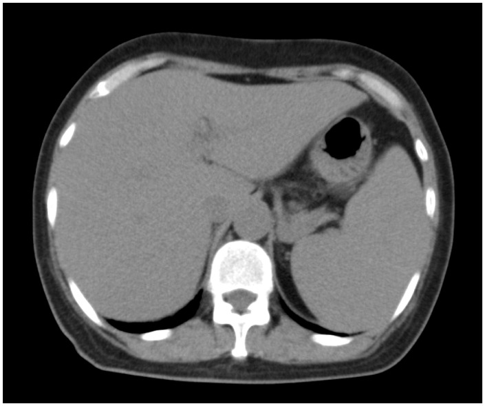 Long-term remission in a patient with NK/T cell intravascular lymphoma with autologous hematopoietic cell transplantation.