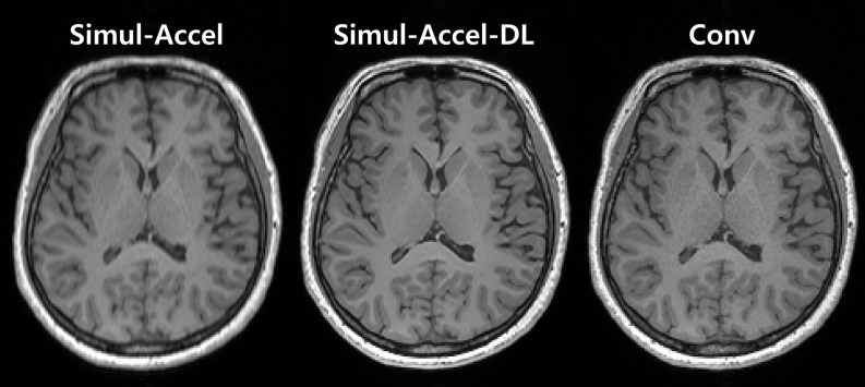 Reliability of brain volume measures of accelerated 3D T1-weighted images with deep learning-based reconstruction.