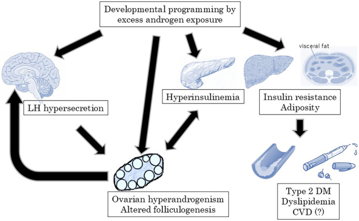 Polycystic ovary syndrome: Criteria, phenotypes, race and ethnicity.