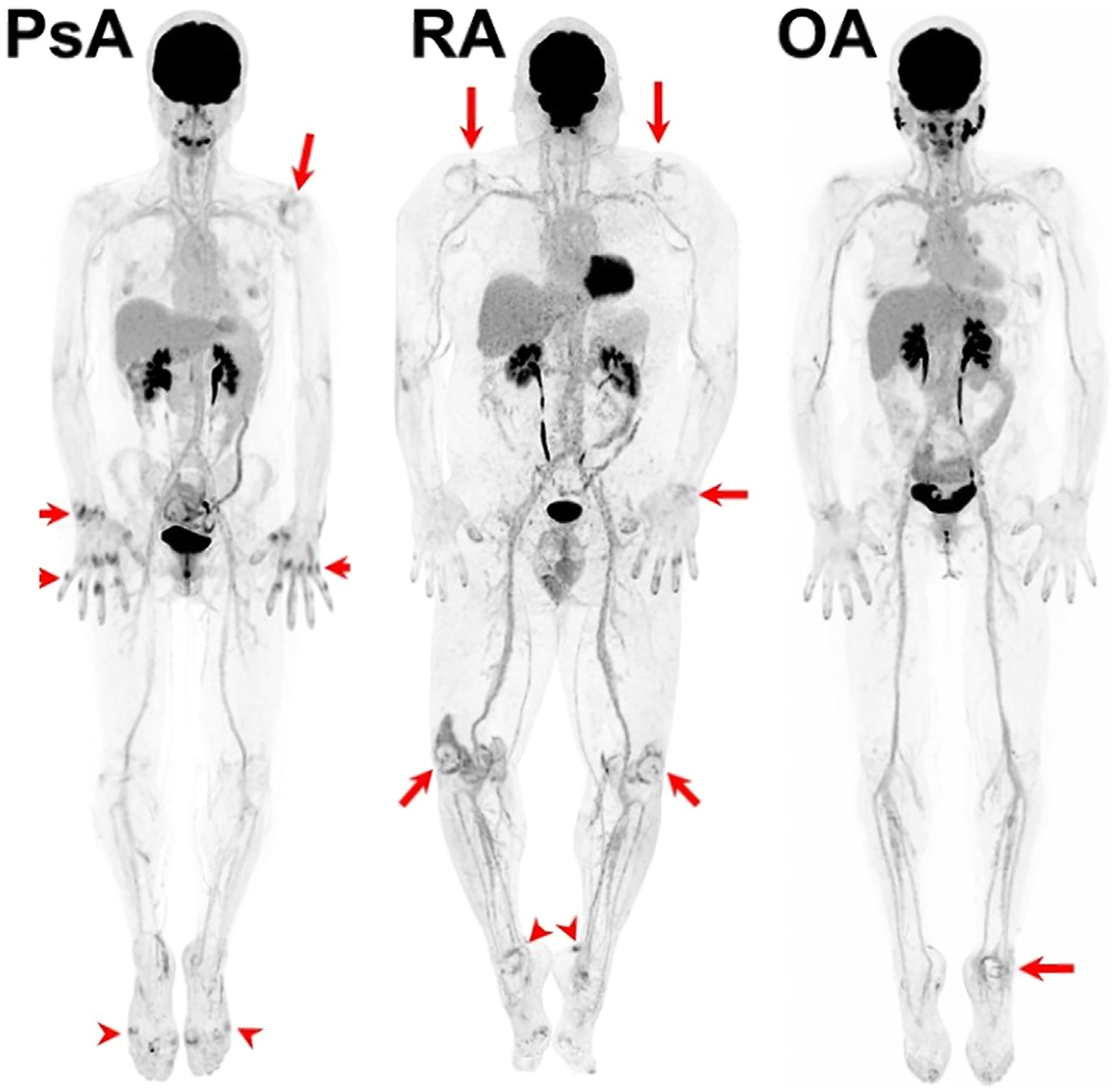 Role of Total Body PET/CT in Inflammatory Disorders
